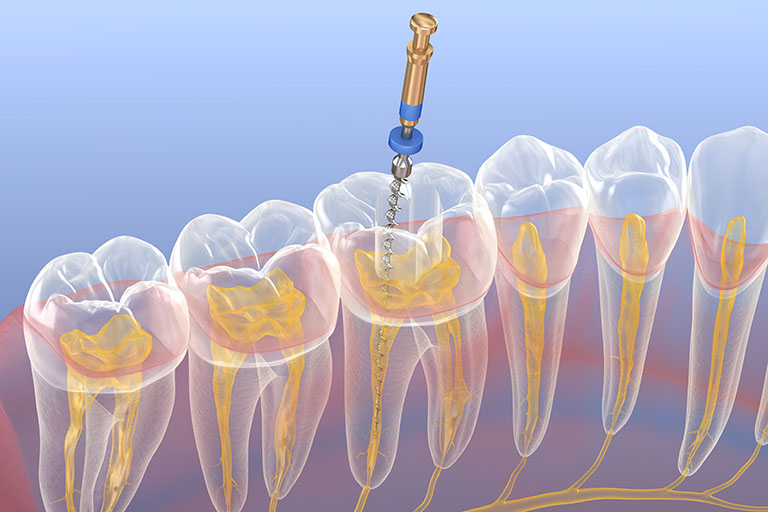 endo probe illustration